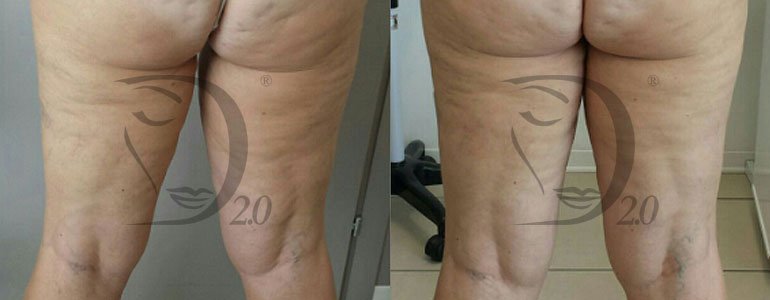 Trattamento anticellulite, Trattamento anticellulite efficace Derma-Celu. Utilizzabile per trattamenti cellulite a tutti gli stadi. 100% Made in Italy, trattamento drenante