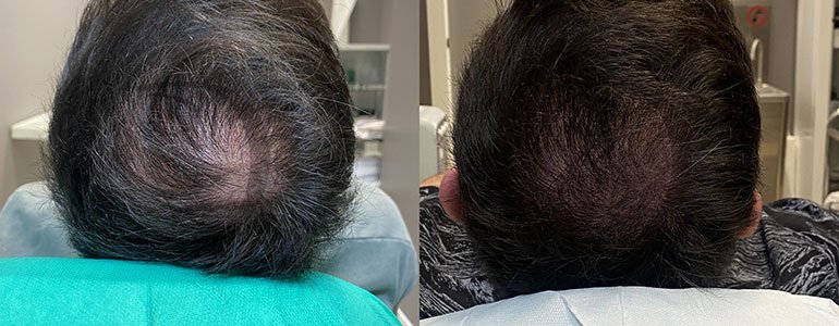 Fiale anticaduta capelli, fiale per capelli, trattamento anticaduta, fiale anticaduta fortificanti, derma-hair, made in italy, derma 2.0
