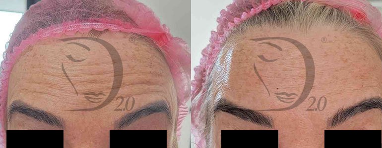 Fiale viso effetto lifting istantaneo con argirelina e leuphasyl al 5% Derma-lifting