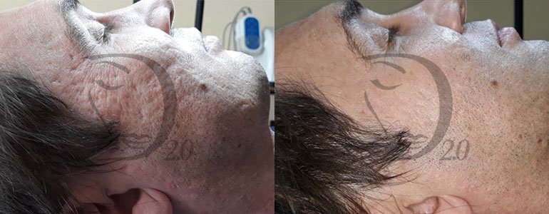Trattamento cicatrici, Trattamento smagliature, trattamento cicatrici, trattamento rigenerante; come Eliminare le smagliature bianche, trattamento cicatrici acne con Derma-Repair