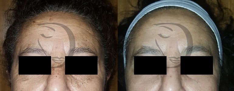 Trattamento schiarente viso, Trattamento macchie viso, trattamento illuminante viso e trattamento schiarente viso Derma-Whitening - Derma 2.0 Made in Italy