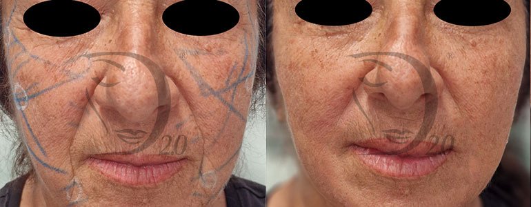 filler zigomi e mandibola, filler zigomi, filler mandibola, filler mento Derma-Fill strong, Derrma 2.0 med, Made in Italy, filler strong, derma 2