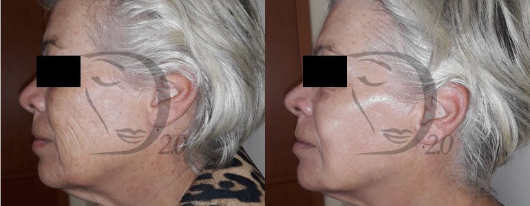 Cocktail completo biorivitalizzante viso, collo, decolletè e mani. Previene e corregge. Biorivitalizzazione viso e trattamento aging con biorivitalizzante