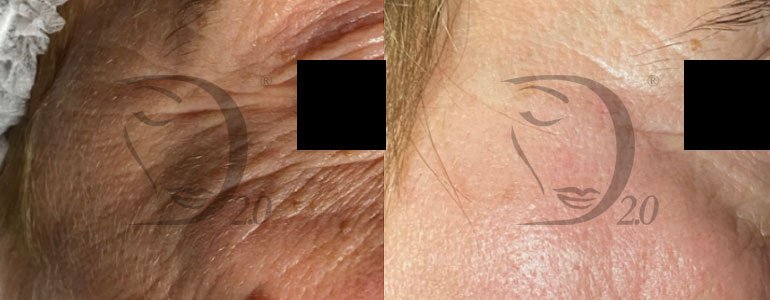 Cocktail completo biorivitalizzante viso, collo, decolletè e mani. Previene e corregge. Biorivitalizzazione viso e trattamento aging con biorivitalizzante