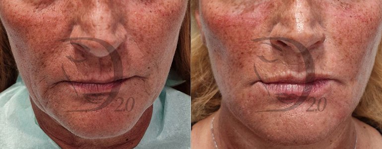 Filler labbra, filler rughe, filler per riempimento labbra, filler per riempimento rughe Derma-fill medium acido ialuronico reticolato 21mg/ml Derma 2.0 med, filler medium, medium, made in italy