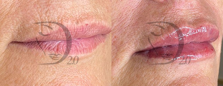 Filler labbra, filler rughe, filler per riempimento labbra, filler per riempimento rughe Derma-fill medium acido ialuronico reticolato 21mg/ml Derma 2.0 med, filler medium, medium, made in italy