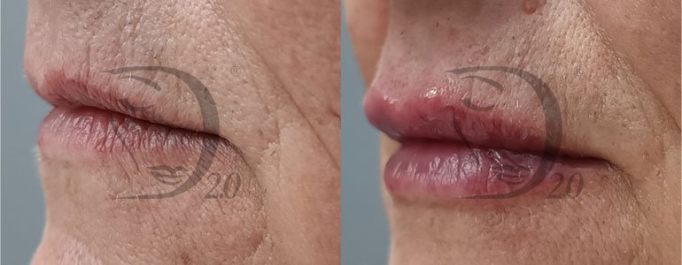 Filler labbra, filler rughe, filler per riempimento labbra, filler per riempimento rughe Derma-fill medium acido ialuronico reticolato 21mg/ml Derma 2.0 med, filler medium, medium, made in italy