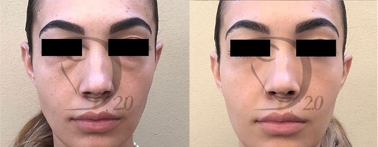Trattamento contorno occhi, trattamento occhiaie cocktail Derma-Eye®. Trattamento completo anti occhiaie e borse occhi illuminante Made in italy