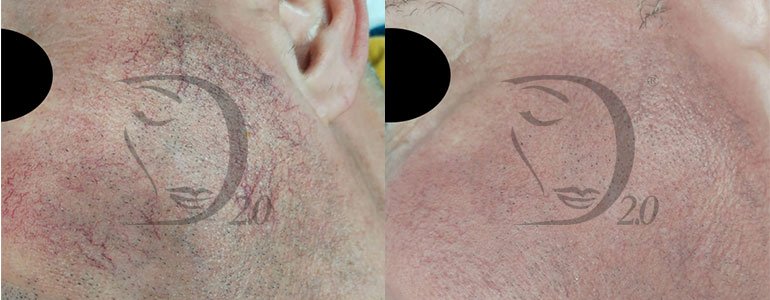 Trattamento pelli sensibili, trattamento pelli reattive, trattamento couperose cocktail completo professionale per veicolazione transdermica in fiale. Derma-Sensitive