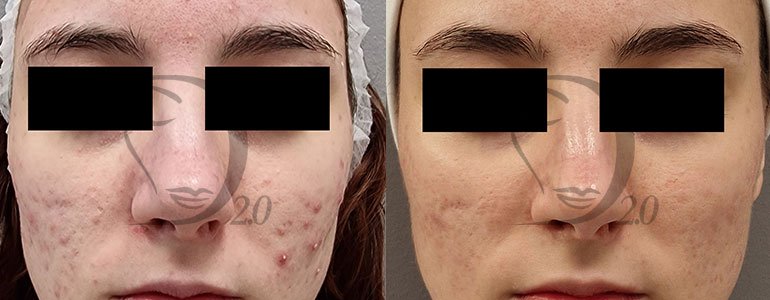 Trattamento pelli grasse, trattamento acne, trattamento pelli impure, trattamento completo anti acne in fiale sterili per elettroporazione