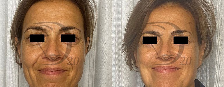 Derma-Esosome Age . Trattamento anti-age a base di esosomi viso, esosomi pelle di Citrus Reticulata, peptidi e acido ialuronico. Derma 2.0 Made in Italy. Esosomi in fiale sterili
