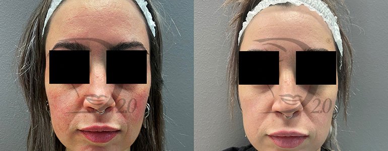 Derma-Esosome Age . Trattamento anti-age a base di esosomi viso, esosomi pelle di Citrus Reticulata, peptidi e acido ialuronico. Derma 2.0 Made in Italy. Esosomi in fiale sterili