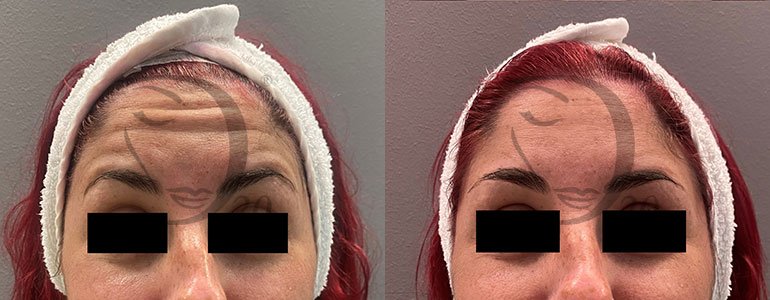 Derma-Esosome Age . Trattamento anti-age a base di esosomi viso, esosomi pelle di Citrus Reticulata, peptidi e acido ialuronico. Derma 2.0 Made in Italy. Esosomi in fiale sterili