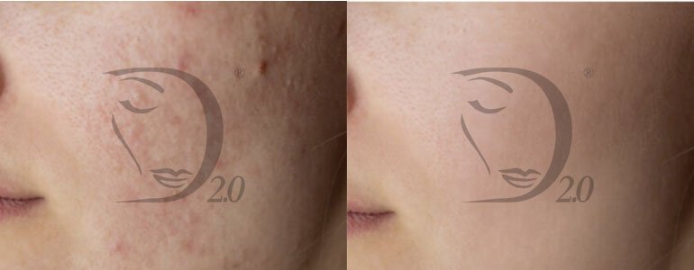Peeling TCA, peeling chimico TCA, peeling TCA viso, Acido TCA peeling, peeling viso TCA