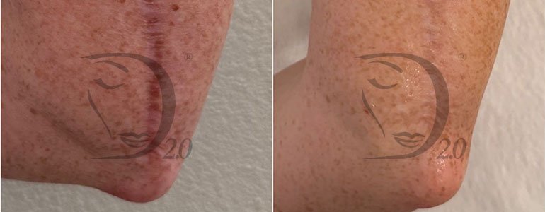Derma-Esosome Rebuild, trattamento, cicatrici, trattamento smagliature, esosomi viso, esosomi pelle, esosomi cicatrici, esosomi atonie, esosomi smagliature, esosomi Zafferano, derma 2.0 italy
