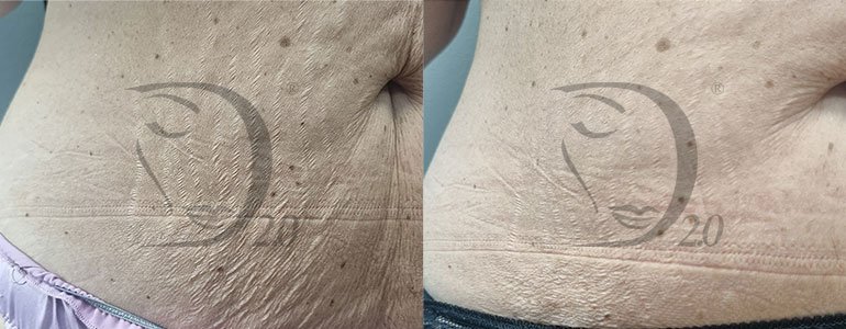 Derma-Esosome Rebuild, trattamento, cicatrici, trattamento smagliature, esosomi viso, esosomi pelle, esosomi cicatrici, esosomi atonie, esosomi smagliature, esosomi Zafferano, derma 2.0 italy