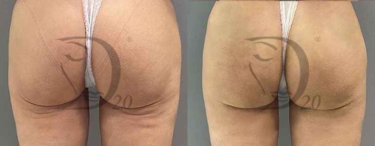 Derma-Esosome Rebuild, trattamento, cicatrici, trattamento smagliature, esosomi viso, esosomi pelle, esosomi cicatrici, esosomi atonie, esosomi smagliature, esosomi Zafferano, derma 2.0 italy