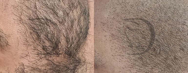 Derma-Esosome Scalp, Esosomi di Ulivo, Esosomi capelli, Esosomi per i capelli, Esosomi per capelli, esosomi anticaduta, trattamento anticaduta capelli, trattamento rinforzante capelli, Esosomi in fiale sterili, Derma 2.0 Made in Italy