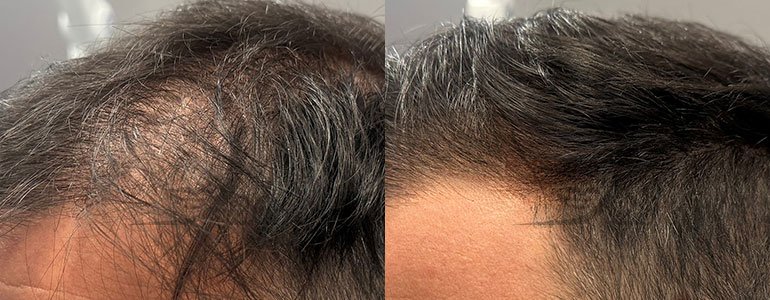 Derma-Esosome Scalp, Esosomi di Ulivo, Esosomi capelli, Esosomi per i capelli, Esosomi per capelli, esosomi anticaduta, trattamento anticaduta capelli, trattamento rinforzante capelli, Esosomi in fiale sterili, Derma 2.0 Made in Italy